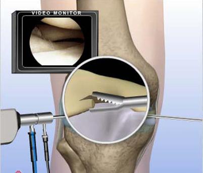 膝关节镜检查诊断特点优势膝和范围价格|膝关